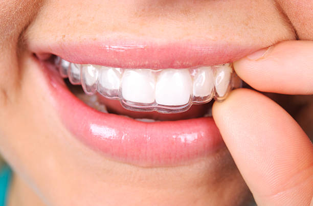 Şeffaf Plaklarla Ortodontik Tedavide Randevu Aralıkları Ne Kadar Olur?