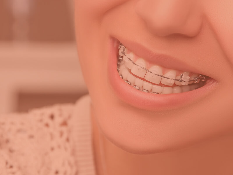 Ortodontik Tedaviler Ne Kadar Sürer?