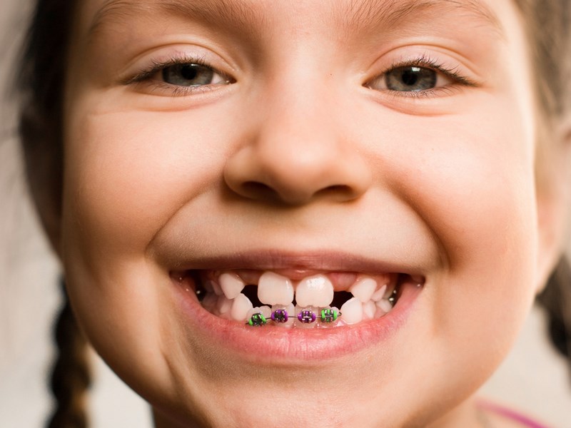 Dişler Neden Çapraşık Olur ve Nasıl Tedavi Edilmelidir?