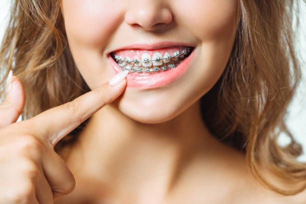 Diş Teli Kullanımı Sırasında Ağız Bakımında Nelere Dikkat Edilmelidir?